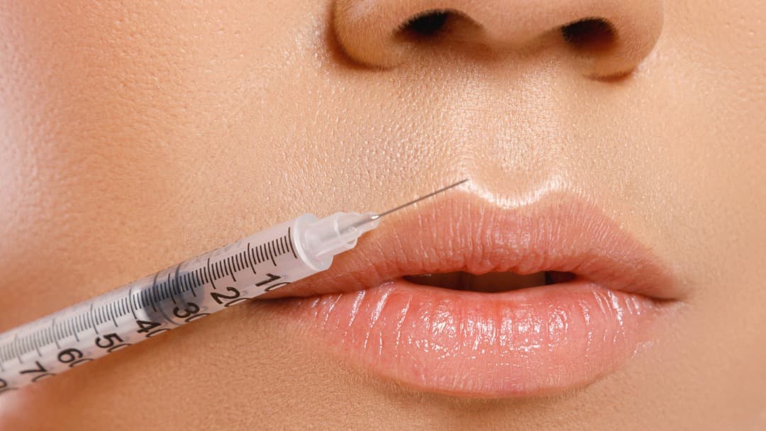 Cover image for: Natural Lip Fillers in Malta: What’s Trending This Year