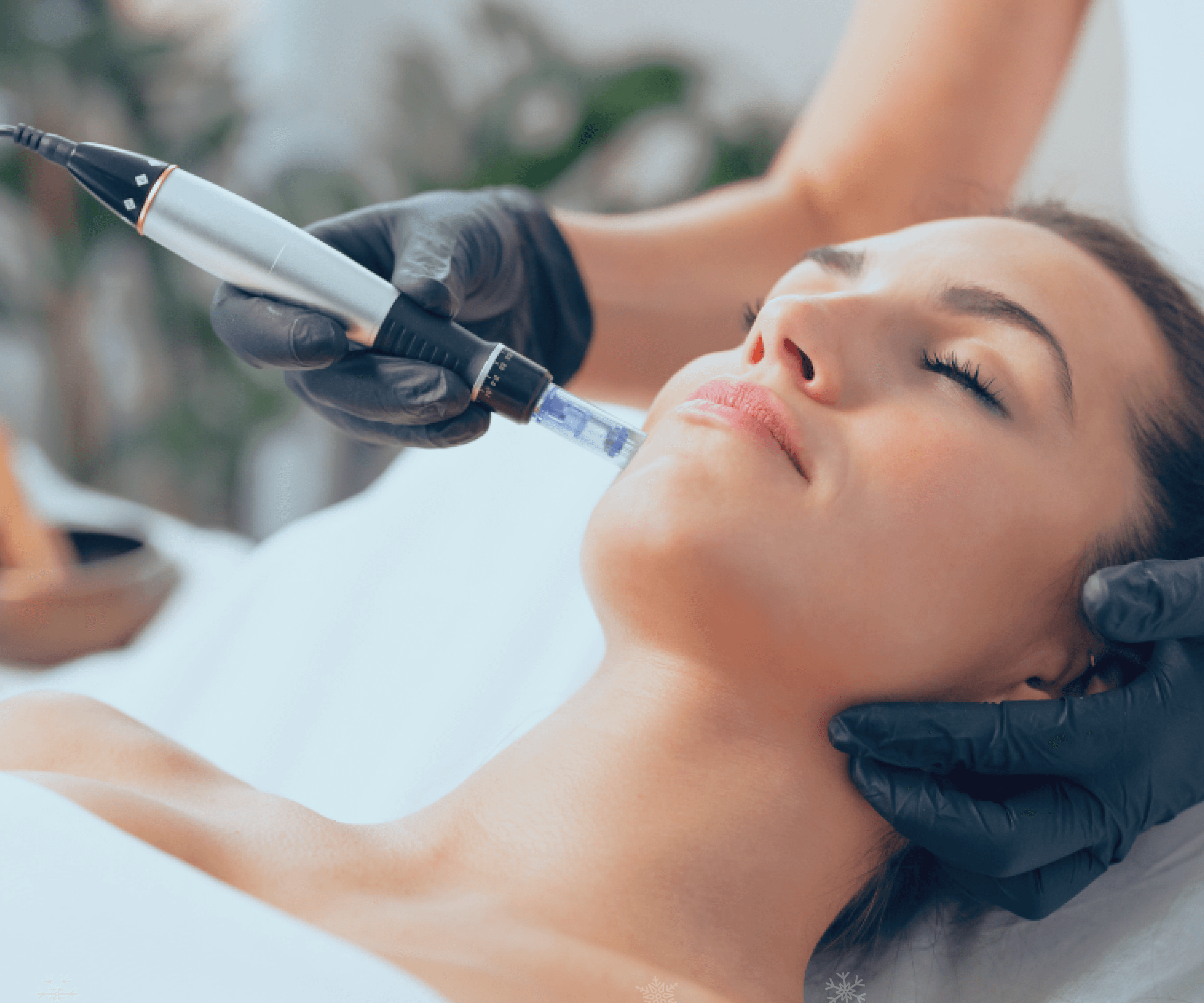 Cover image for: Microneedling This Summer: Yes or No?