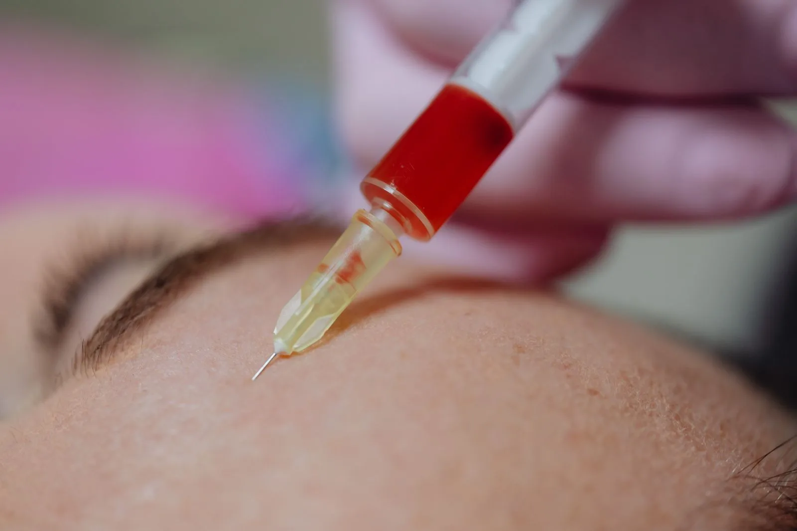 A clinical close-up of a cosmetic syringe, illustrating botox vs fillers cost in Malta