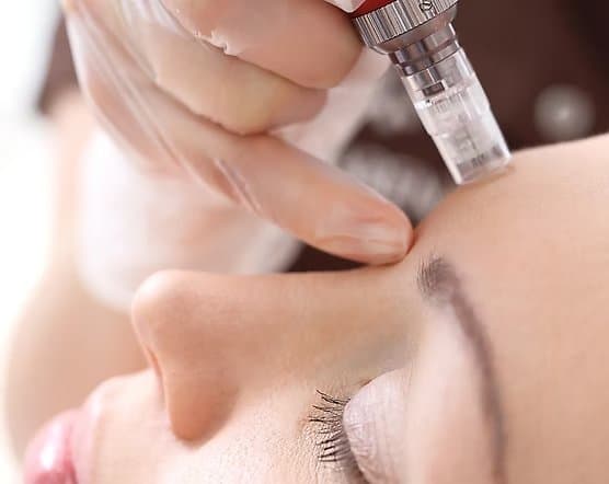 Microneedling with Exosomes