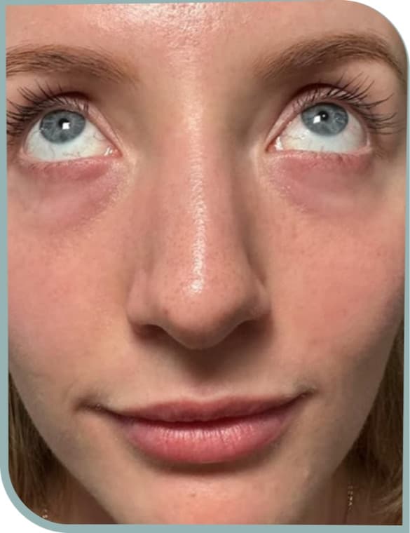 Brighter under-eye skin, Before photo (result 1 of 10)