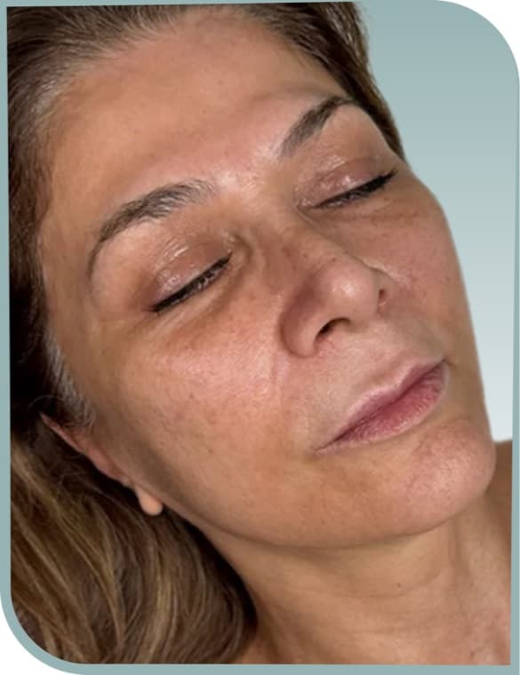Smoother sun-damaged skin, Before photo (result 2 of 10)