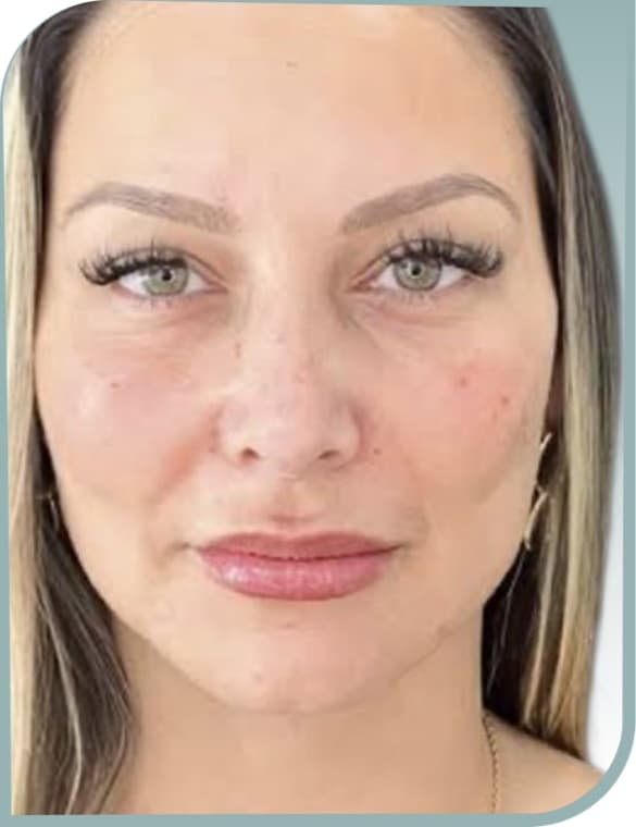 Refreshed under-eyes, After photo (result 10 of 10)