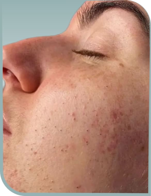 Clearer cheek skin, Before photo (result 3 of 10)
