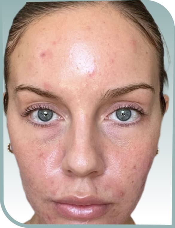 Calmer blemish-prone skin, Before photo (result 4 of 10)