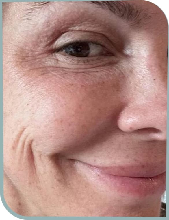 Softer cheek lines, Before photo (result 6 of 10)