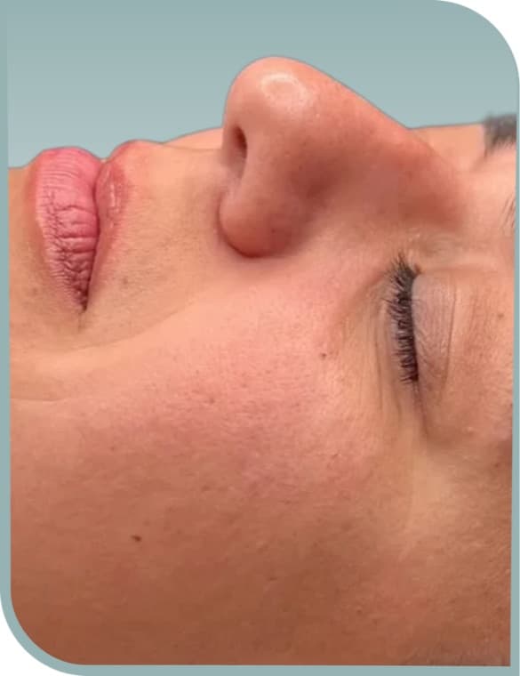 Smoother lip area, Before photo (result 3 of 6)