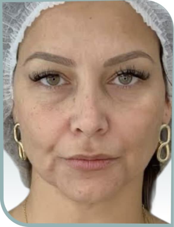 Refreshed under-eyes, Before photo (result 10 of 10)