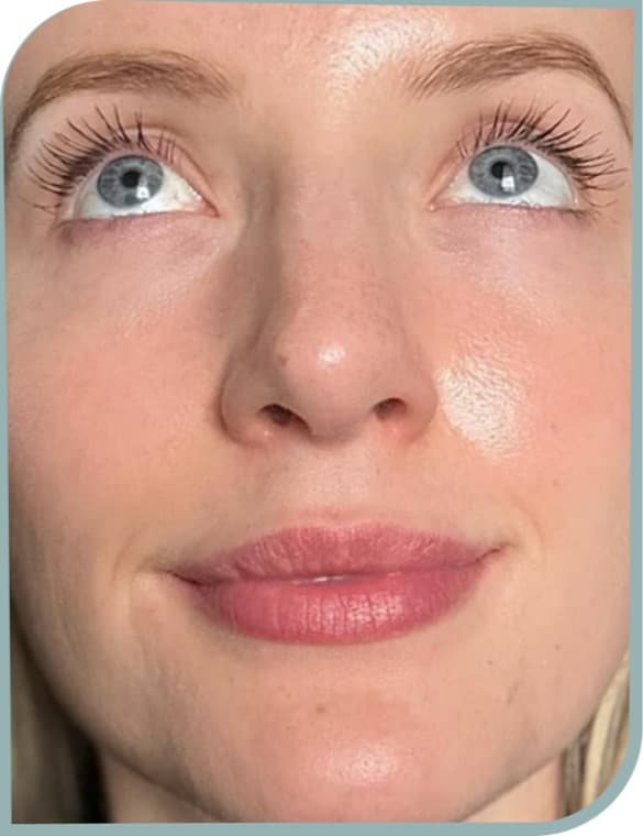 Brighter under-eye skin, After photo (result 1 of 10)