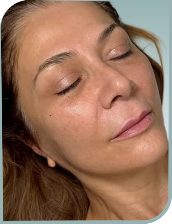 Smoother sun-damaged skin, After photo (result 2 of 10)