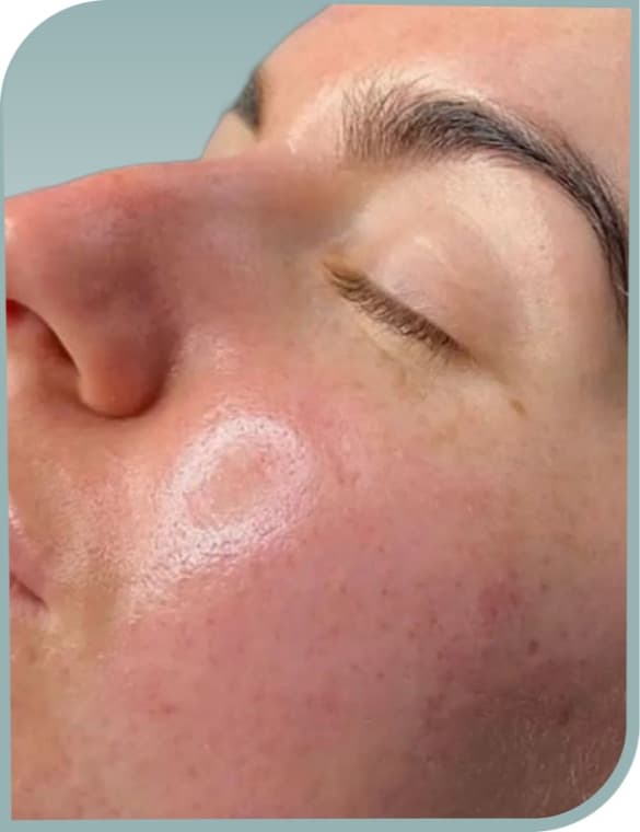 Clearer cheek skin, After photo