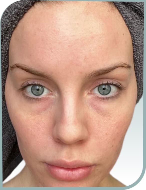 Calmer blemish-prone skin, After photo (result 4 of 10)