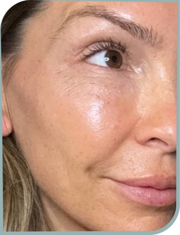 Softer cheek lines, After photo (result 6 of 10)