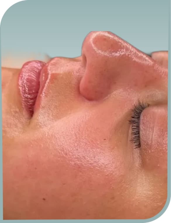 Smoother lip area, After photo (result 3 of 6)