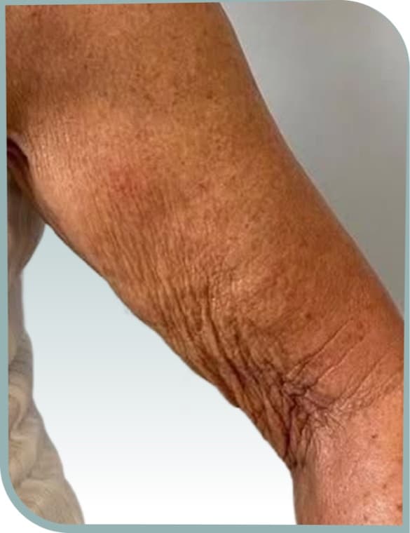 Crepey arm skin, Before photo (result 1 of 10)