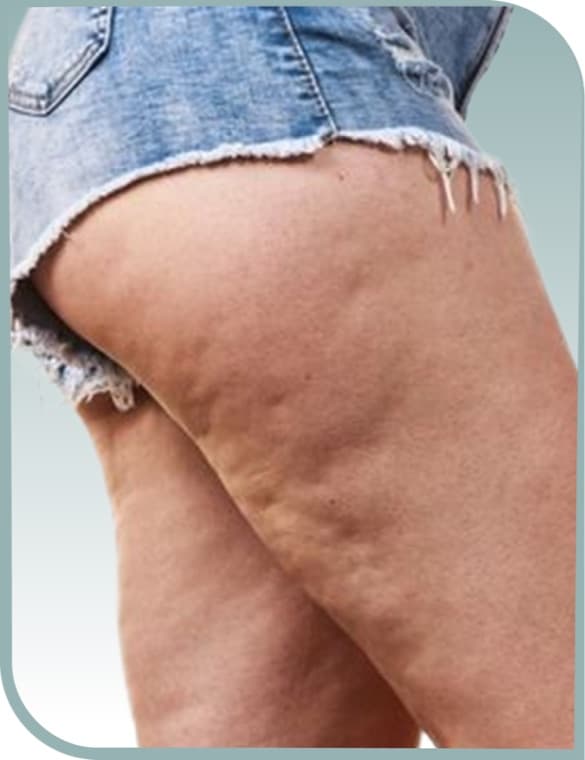 Thigh cellulite, Before photo (result 2 of 10)