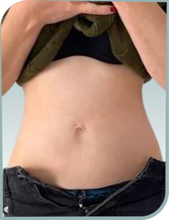 Lax tummy skin, After photo (result 9 of 10)