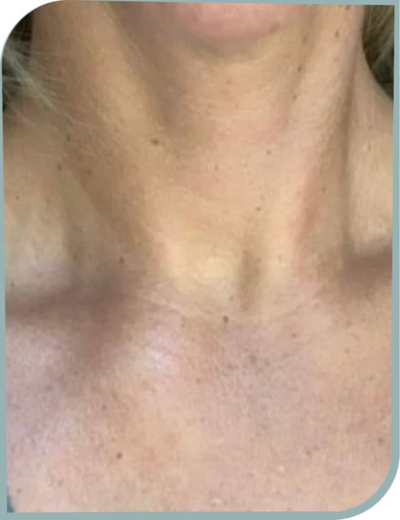 Neck lines, After photo (result 10 of 10)