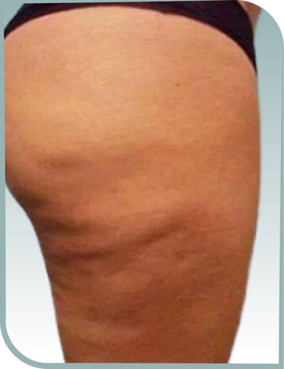 Thigh texture, Before photo (result 3 of 10)