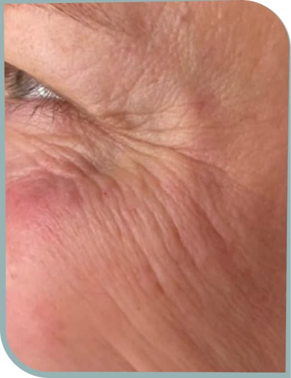 Crow's feet, Before photo (result 4 of 10)