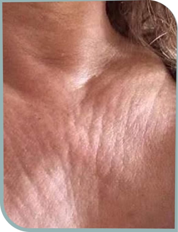 Chest crepiness, Before photo (result 5 of 10)