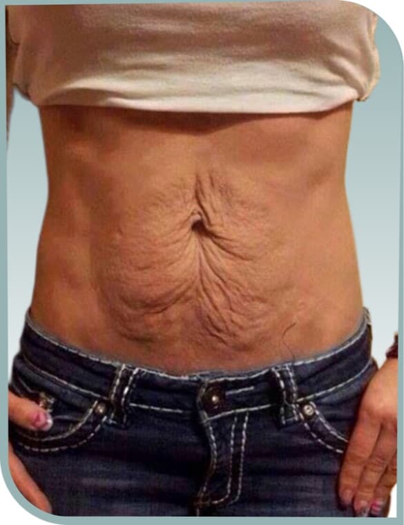 Loose tummy skin, Before photo (result 7 of 10)