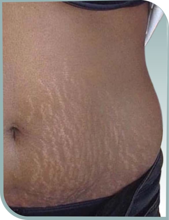 Stretch marks, Before photo (result 8 of 10)