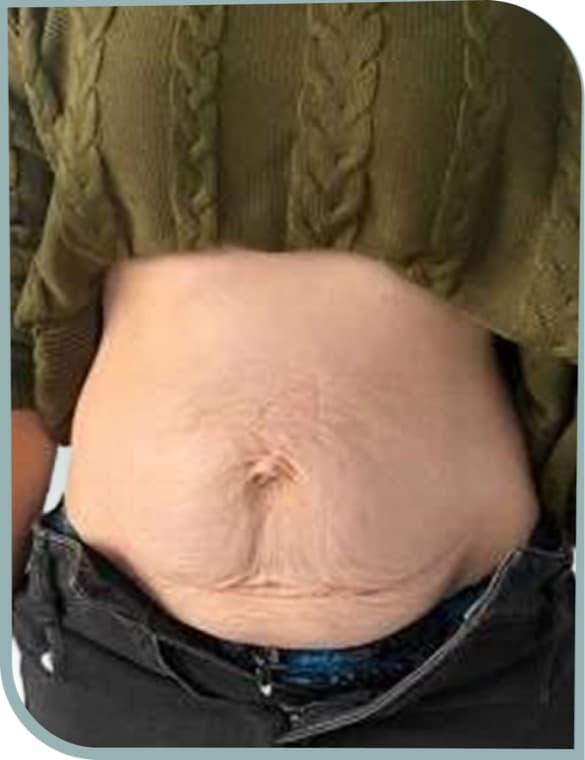 Lax tummy skin, Before photo (result 9 of 10)