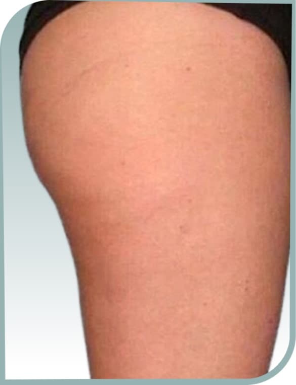 Thigh texture, After photo (result 3 of 10)