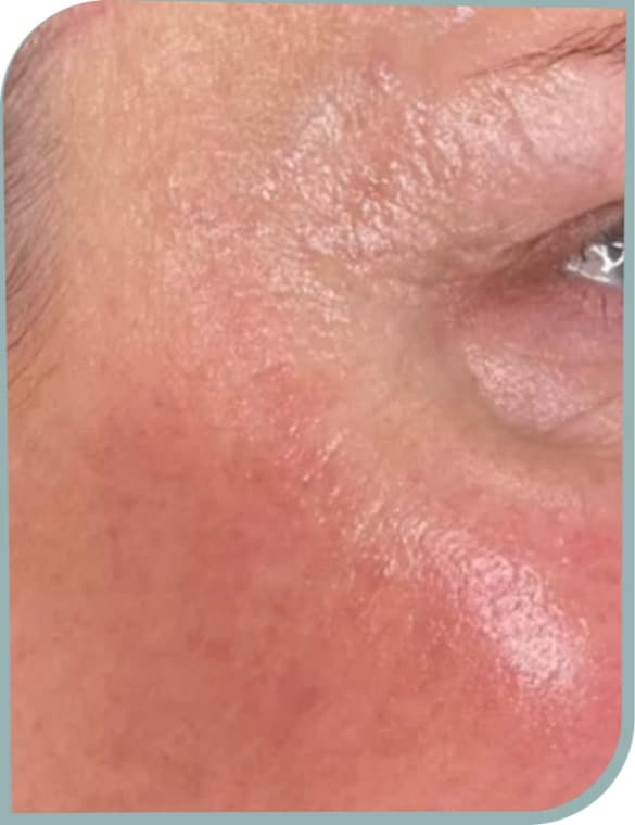Crow's feet, After photo (result 4 of 10)