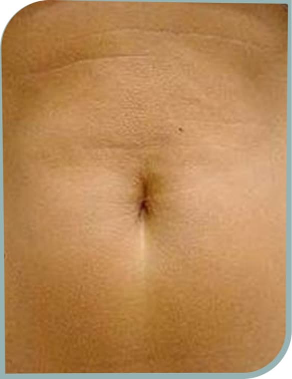 Crepey tummy skin, After photo (result 6 of 10)