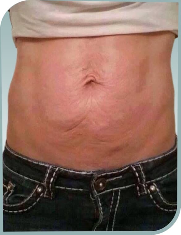 Loose tummy skin, After photo (result 7 of 10)