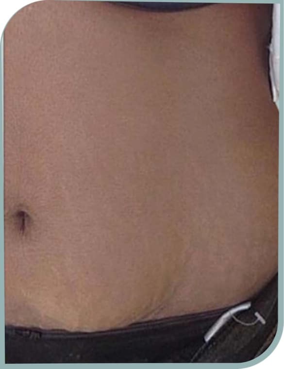 Stretch marks, After photo (result 8 of 10)