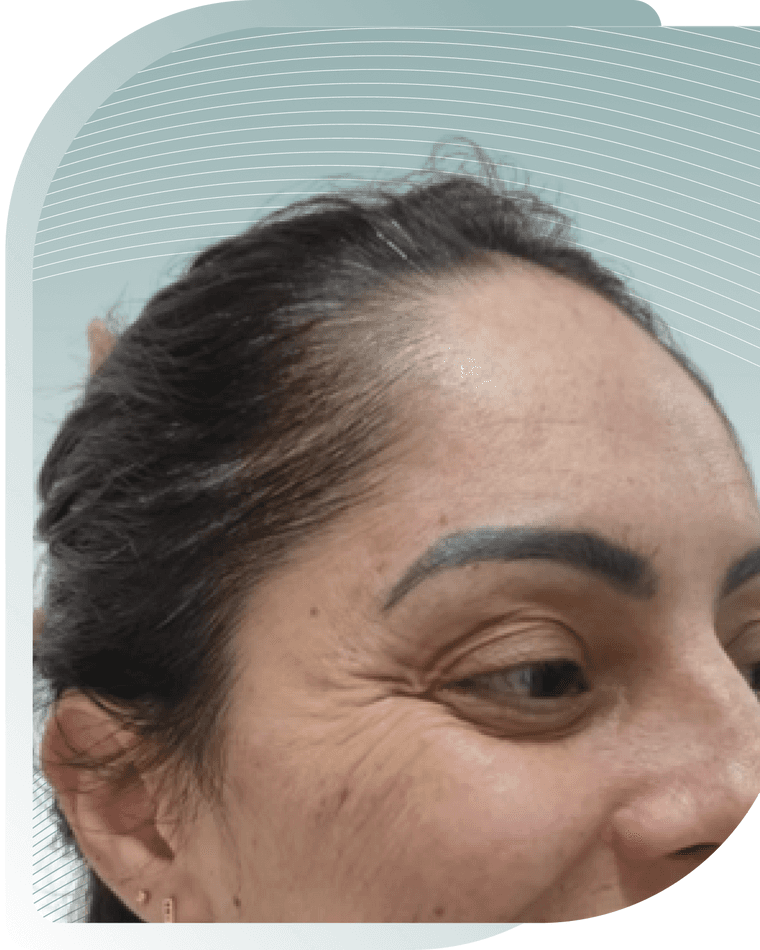 BOTOX RESULTS — After photo (result 2 of 4)