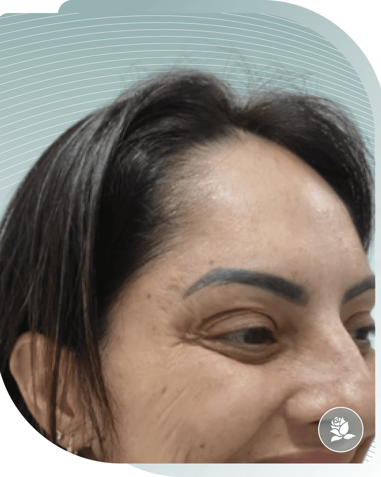 BOTOX RESULTS — Before photo (result 2 of 4)