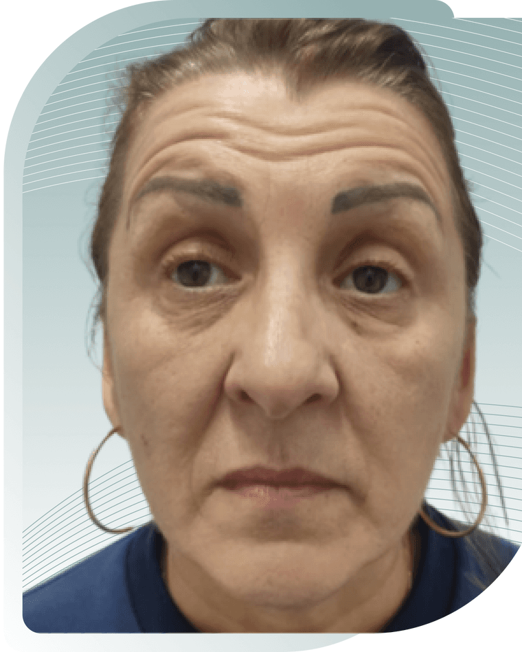 BOTOX RESULTS — After photo (result 3 of 4)
