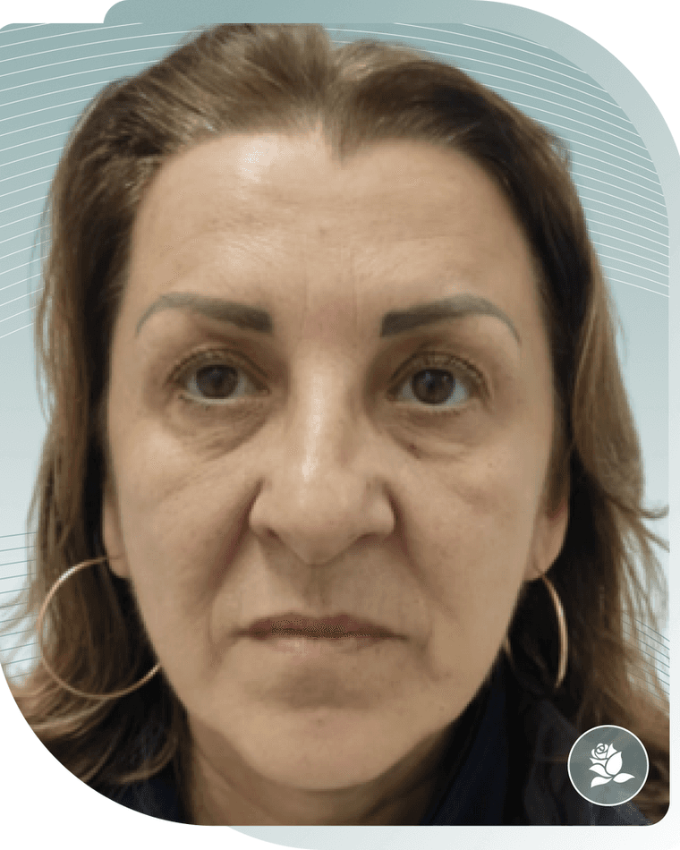 BOTOX RESULTS — Before photo (result 3 of 4)