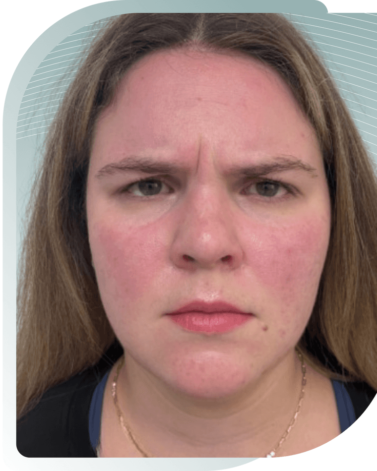 BOTOX RESULTS — After photo (result 4 of 4)