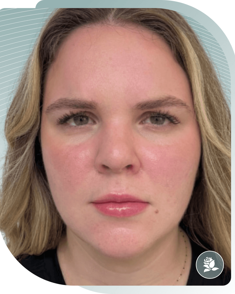 BOTOX RESULTS — Before photo (result 4 of 4)