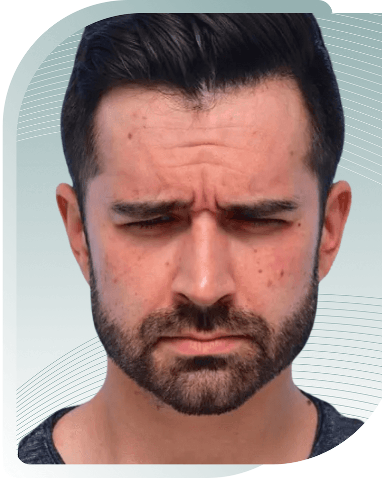 BOTOX RESULTS — After photo (result 1 of 4)