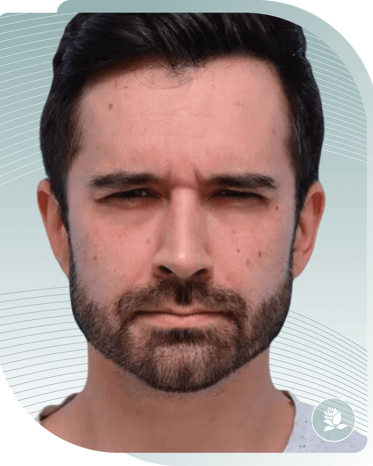 BOTOX RESULTS — Before photo (result 1 of 4)