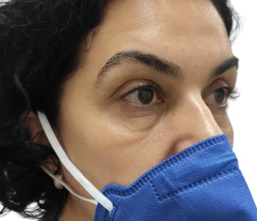 After photo: Chemical Peels result at Carisma Aesthetics Malta