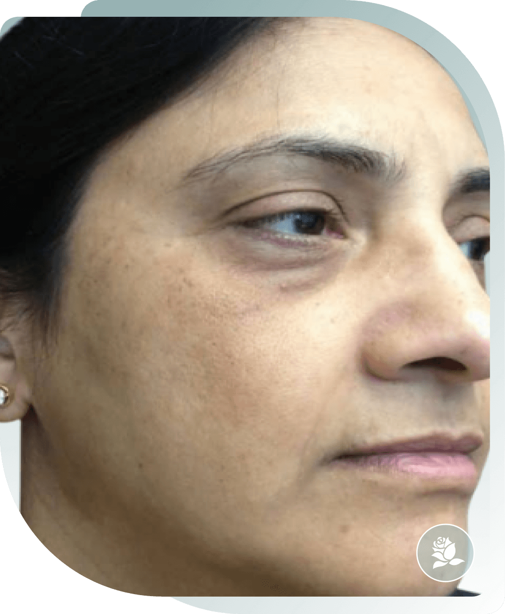 Under-Eye Pigmentation — After photo (result 1 of 5)