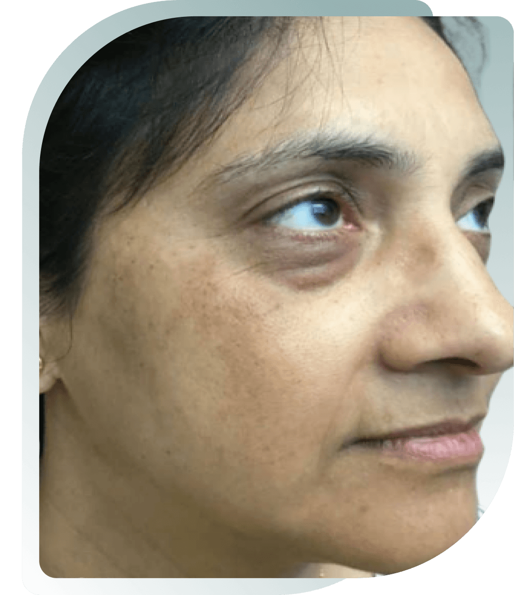 Under-Eye Pigmentation — Before photo (result 1 of 5)