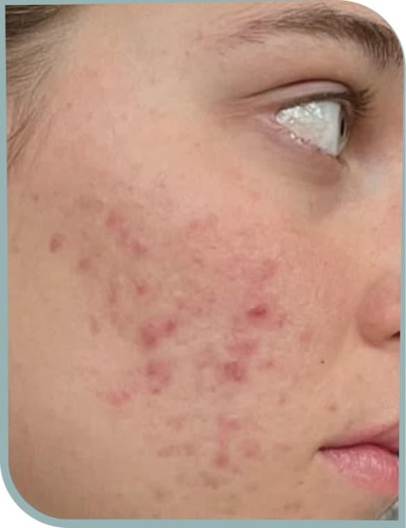 Acne and redness, Before photo (result 2 of 10)