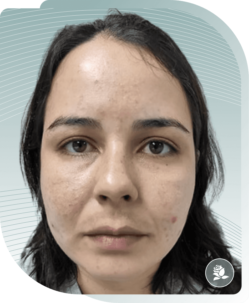Acne & Redness — After photo (result 2 of 5)