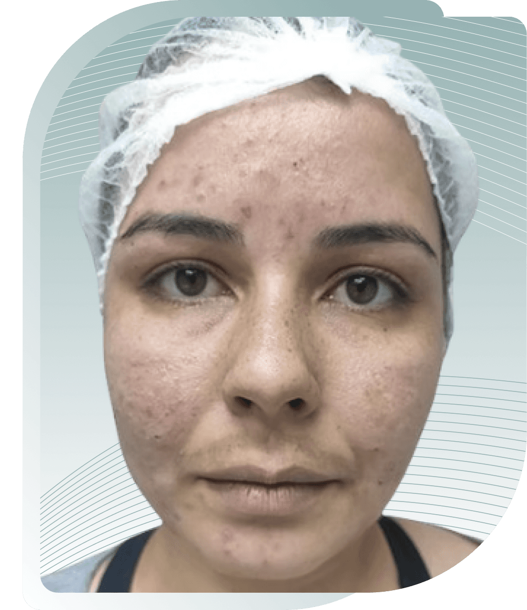 Acne & Redness — Before photo (result 2 of 5)
