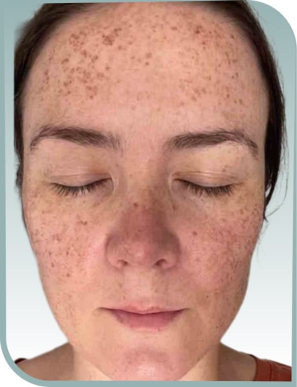 Freckles and sun spots, Before photo (result 3 of 10)
