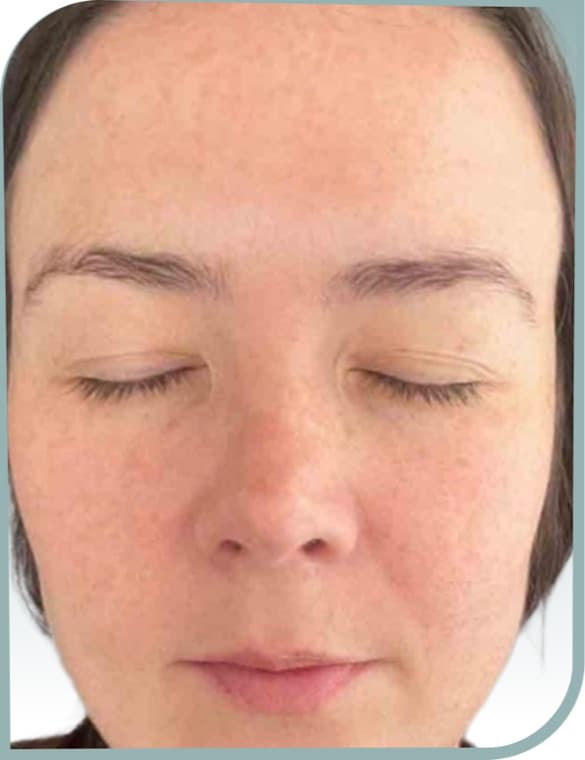 Freckles and sun spots, After photo (result 3 of 10)