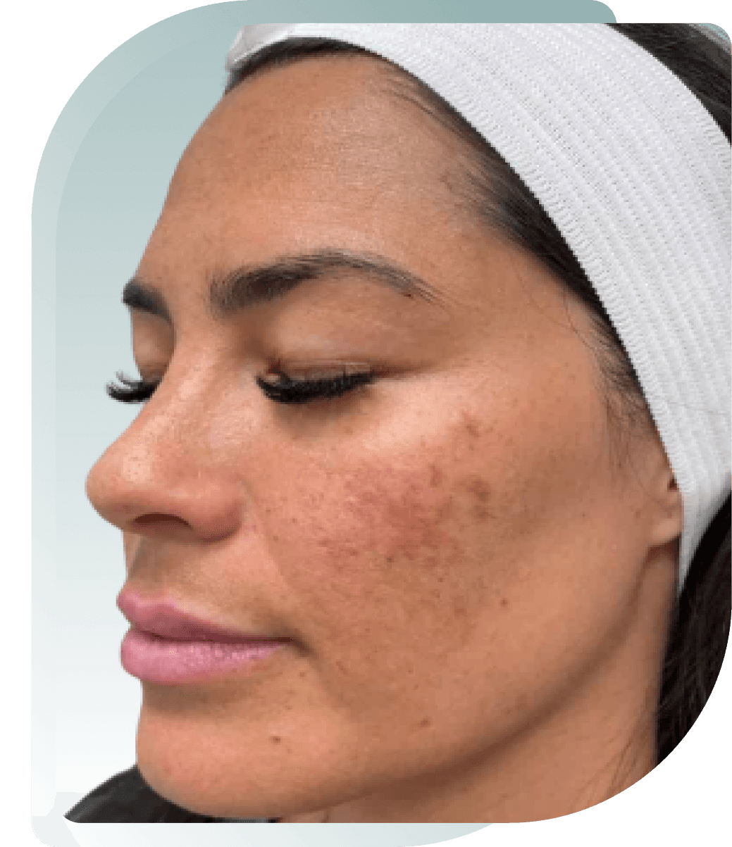 Hyperpigmentation — After photo (result 3 of 5)